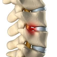 Найчастіше однією з причин появи болів в спині є грижа міжхребцевого диска