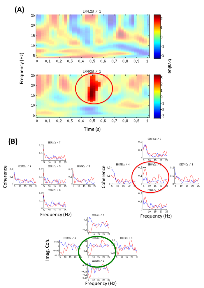 Малюнок 4: Частотно-часовий аналіз потужності і EEG-LFP Узгодженість (з прикладу 2) (А) Локальна коливальна потужність контрастні нейтрально в порівнянні зі звичною адресації умови для першої секунди ;
