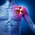 При травматизації плечового суглоба може виникнути розрив зв'язок плеча